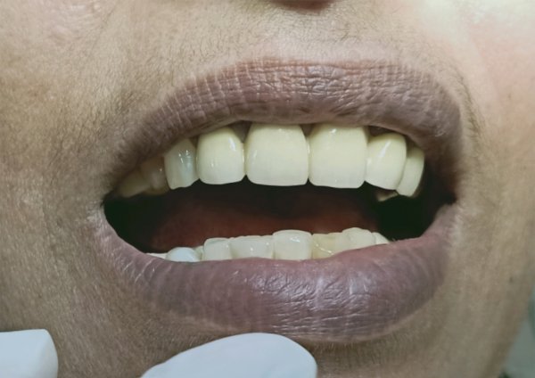 After-Dental Implant