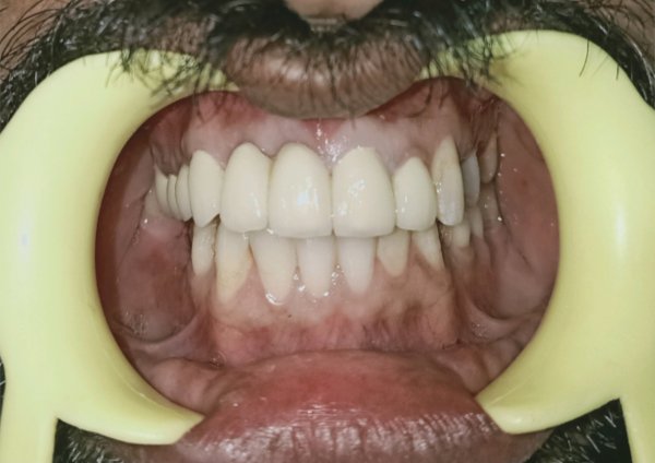 After-Mouth Rehabilitation