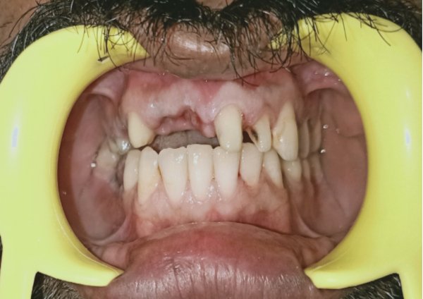 Before-Mouth Rehabilitation